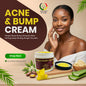 Acne & Bump Cream -(6 Pieces) @ $5.75/each