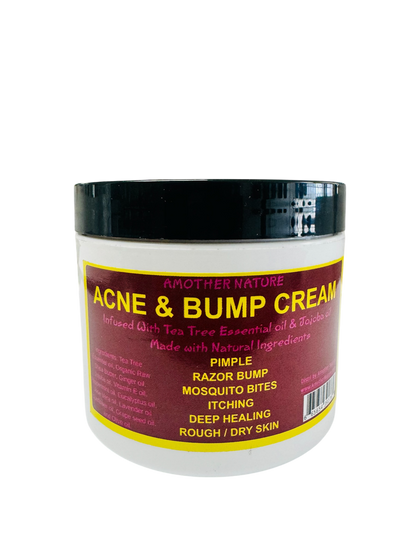 Acne & Bump Cream -(6 Pieces) @ $5.75/each