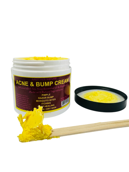 Acne & Bump Cream -(6 Pieces) @ $5.75/each